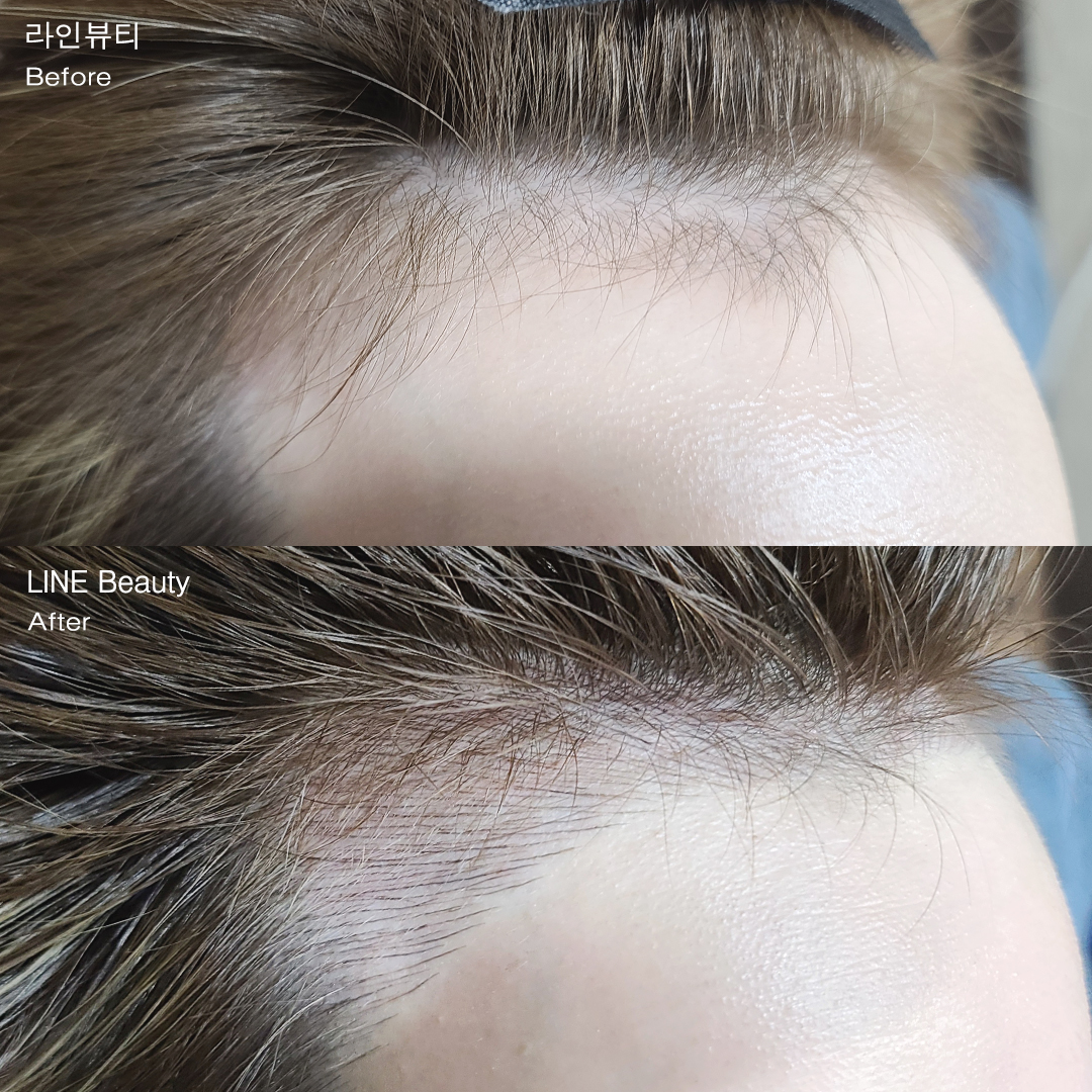 헤어라인 반영구화장